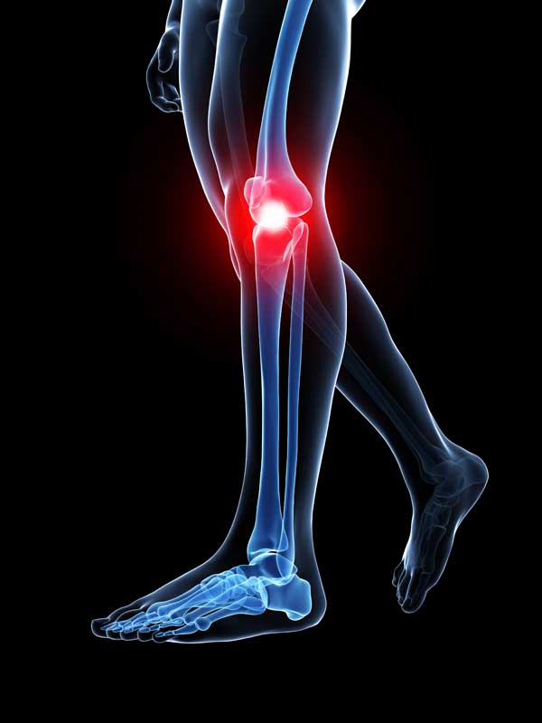 3d rendered medical illustration - painful knee